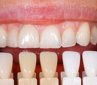 Composite Resin Veneers