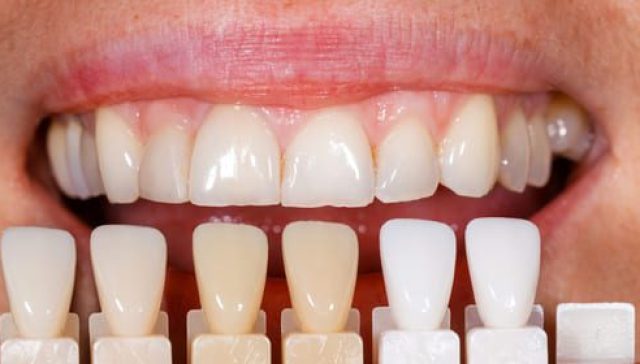 Composite Resin Veneers