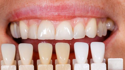 Composite Resin Veneers