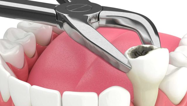 Tooth Extraction Aftercare