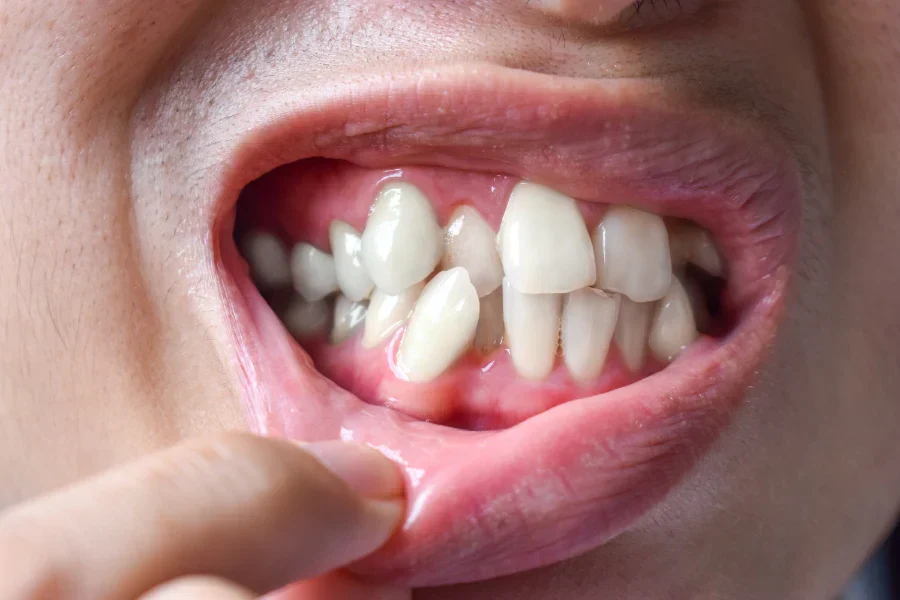 Crooked Bottom Teeth Why You Shouldn t Ignore Them El Shenawy 