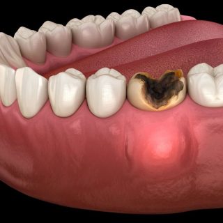 Tooth Abscess Treatment