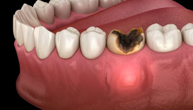 Tooth Abscess Treatment