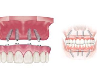 Zygomatic Dental Implants