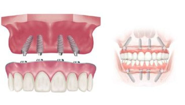 Zygomatic Dental Implants