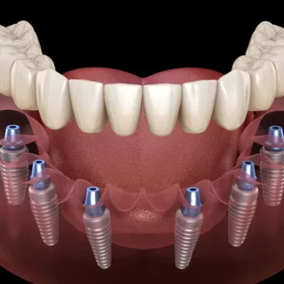 Full Arch Dental Implants