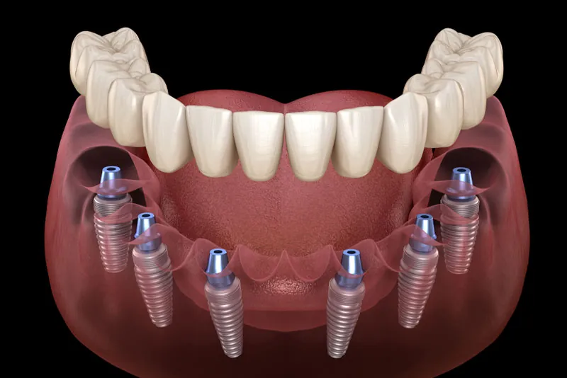 Full Arch Dental Implants