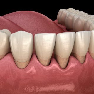 Root Planing of Teeth