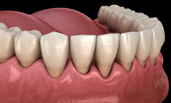 Root Planing of Teeth