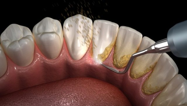 Calculus Bridge Teeth
