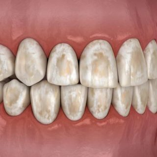 Brown Stain on Teeth