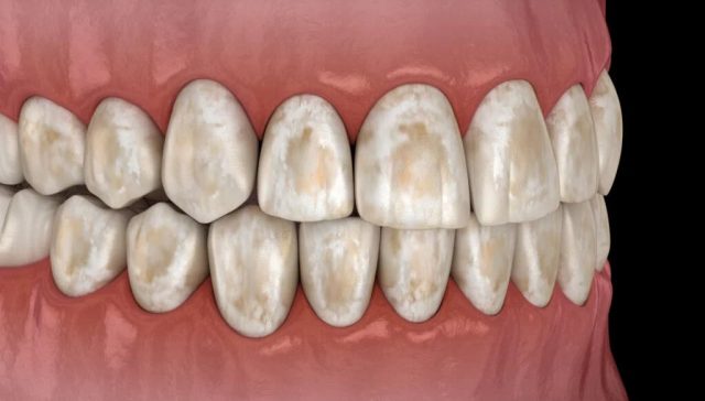 Brown Stain on Teeth