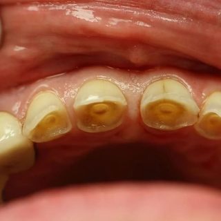 Tooth Enamel Erosion