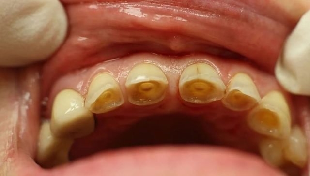 Tooth Enamel Erosion