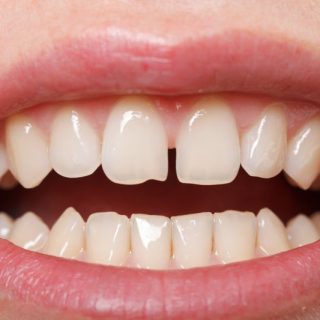 Diastema of Teeth