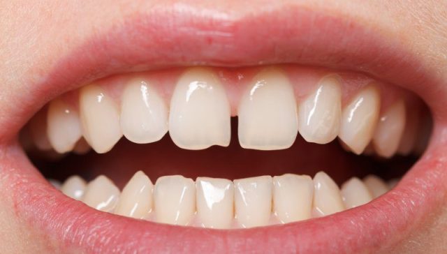Diastema of Teeth