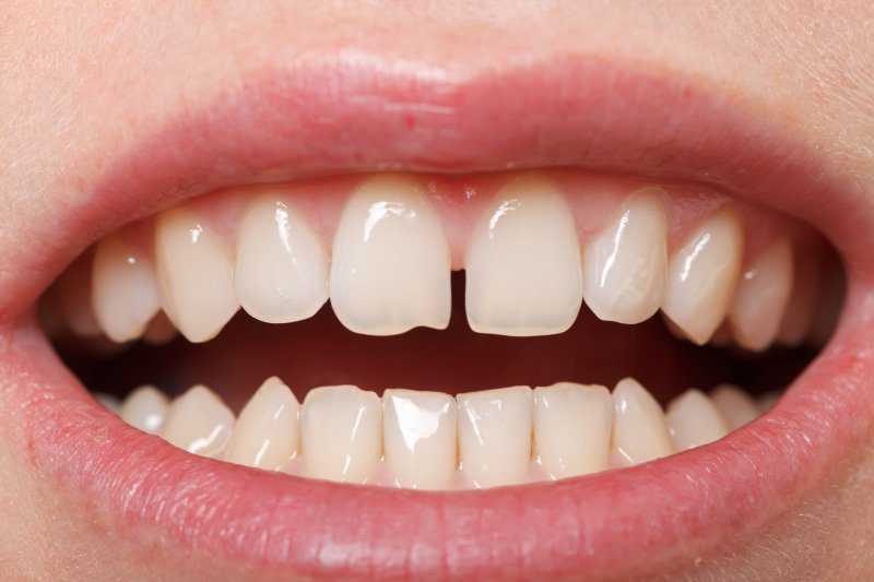 Diastema of Teeth
