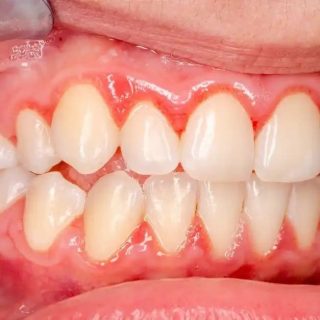 Gingivitis and Periodontal