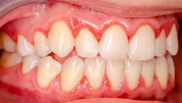 Gingivitis and Periodontal