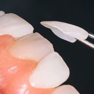 Laminate veneers teeth