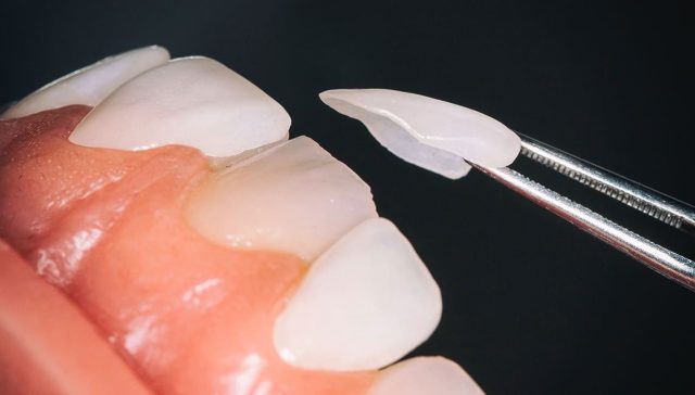 Laminate veneers teeth
