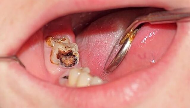 cause of toothache