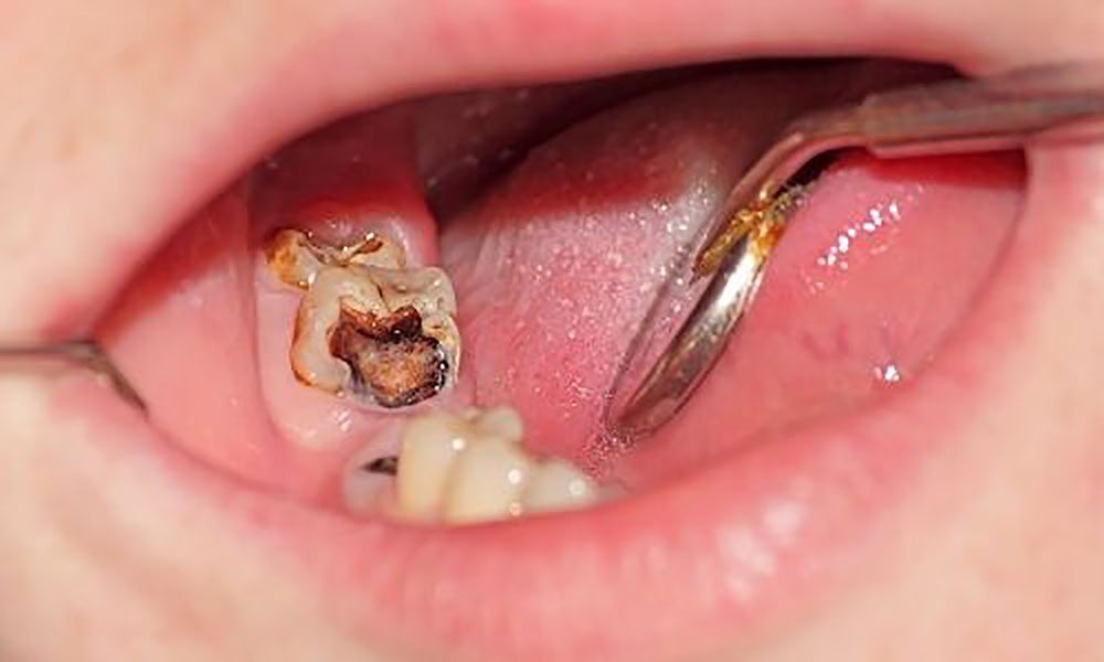 cause of toothache