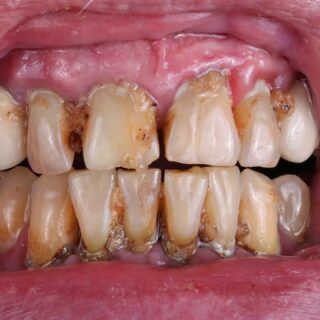 Alcohol and Oral Health