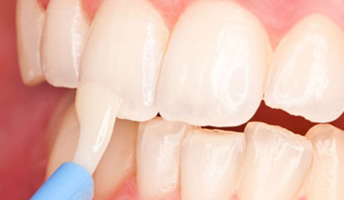 Fluoride Treatment for Teeth