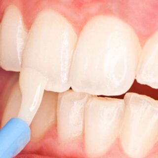 Fluoride Treatment for Teeth