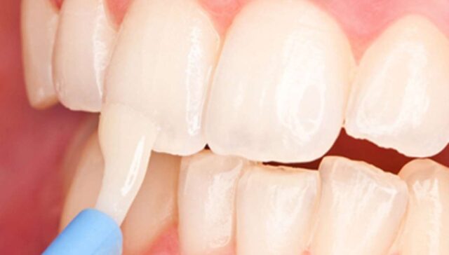 Fluoride Treatment for Teeth