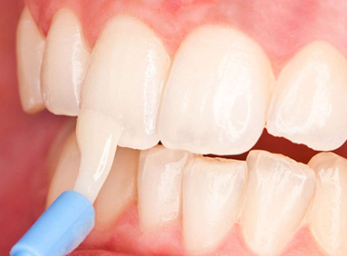 Fluoride Treatment for Teeth