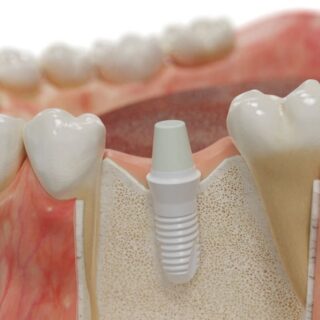 Ceramic Dental Prosthesis