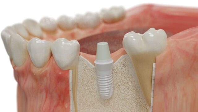 Ceramic Dental Prosthesis