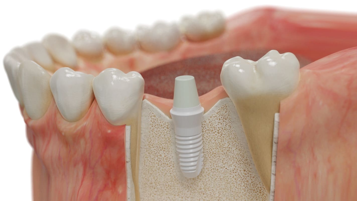 Ceramic Dental Prosthesis