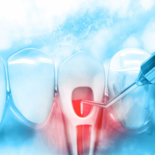 Laser root canal treatment