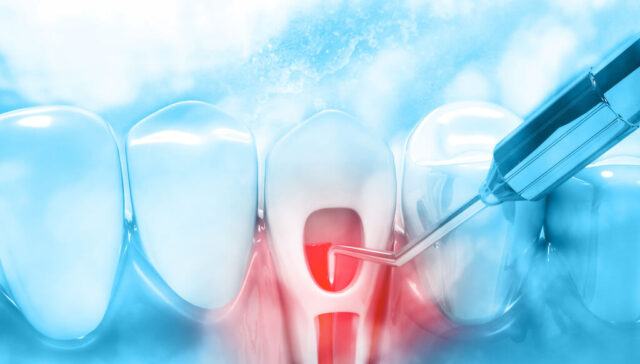 Laser root canal treatment