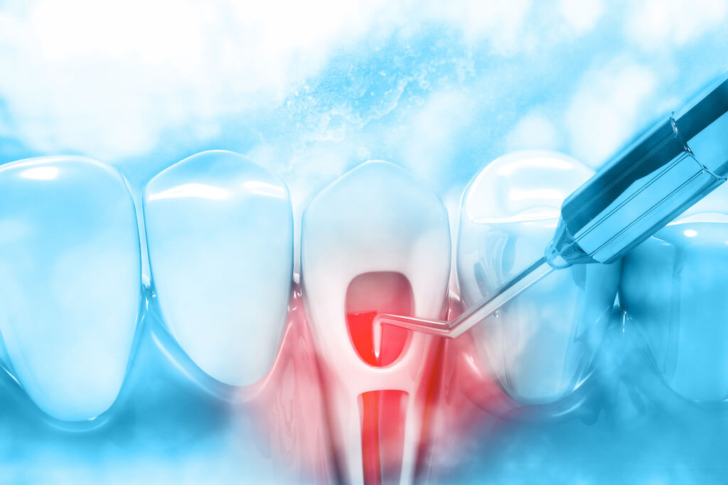 Laser root canal treatment