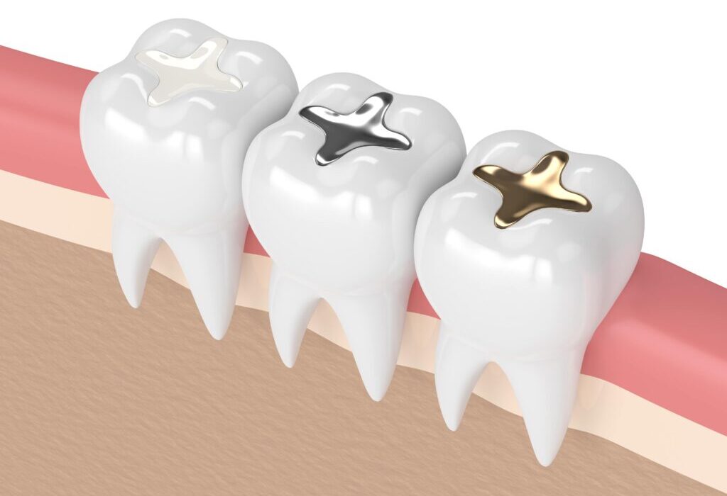 tooth filling material types
