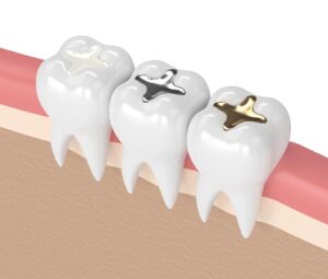 tooth filling material types