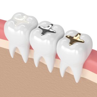 tooth filling material types