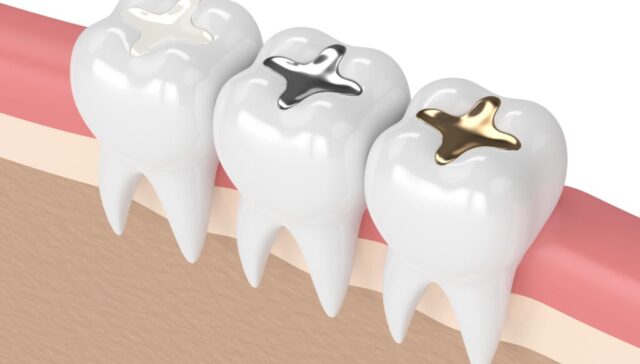 tooth filling material types