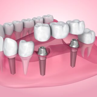 dental crowns and bridges