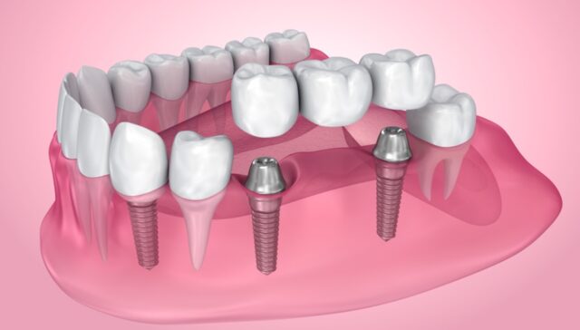 dental crowns and bridges