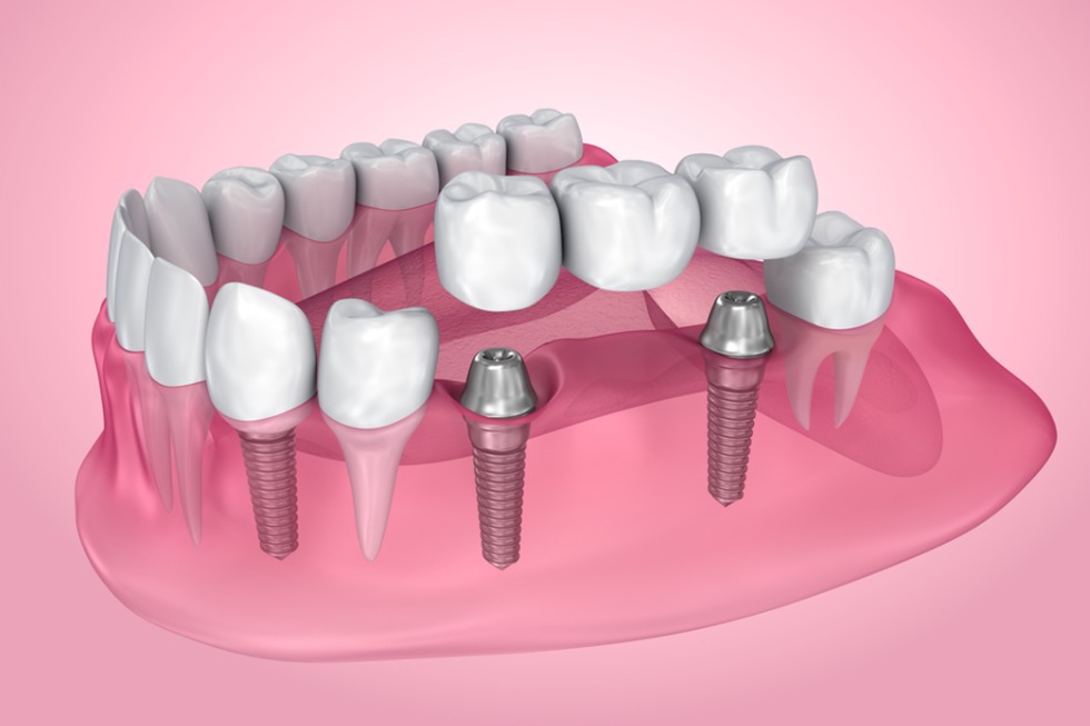 dental crowns and bridges