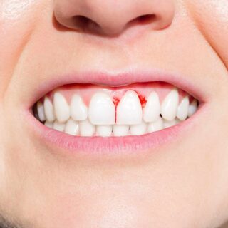 Gum Bleeding Causes
