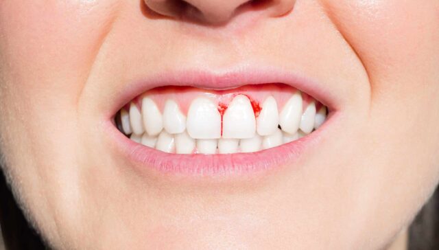 Gum Bleeding Causes