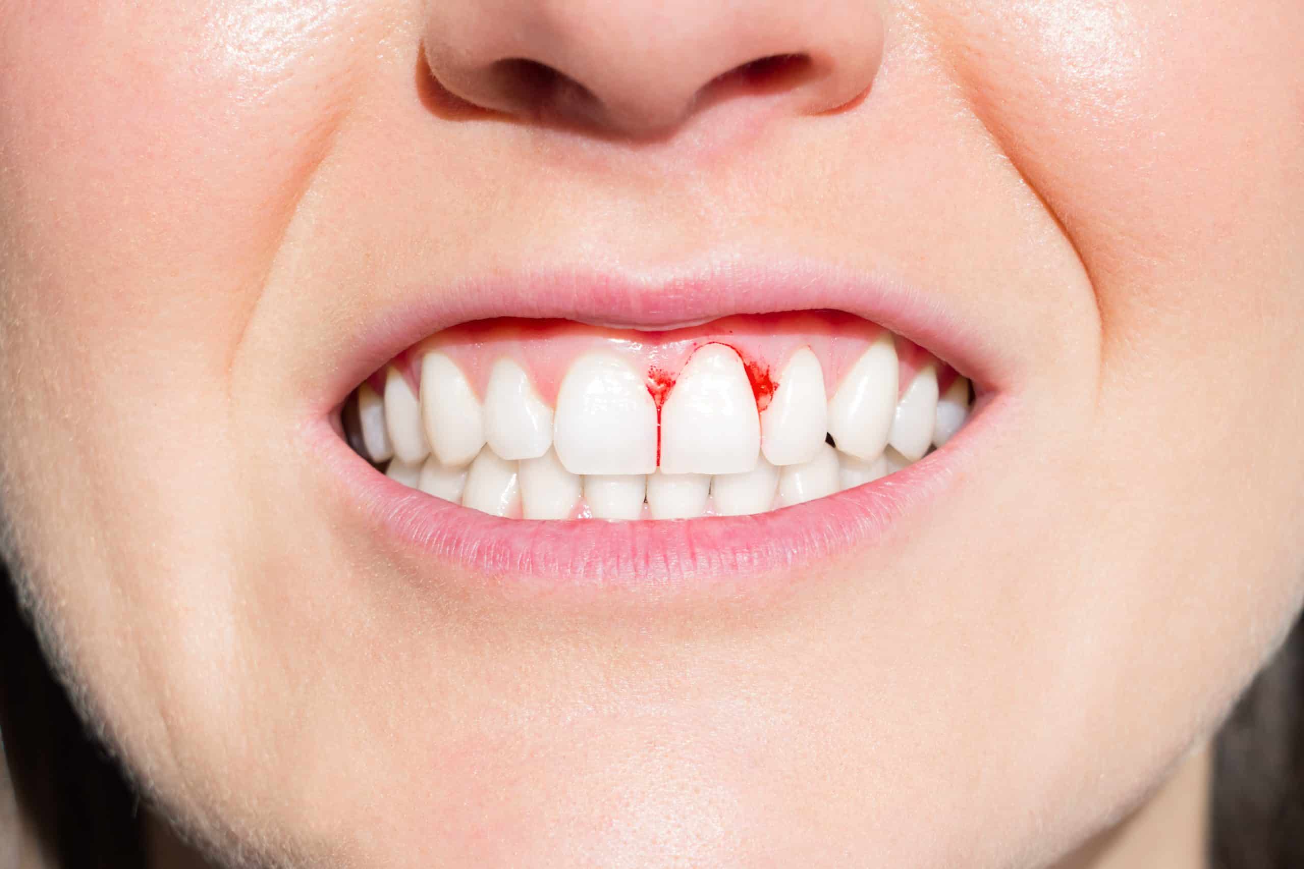 Gum Bleeding Causes
