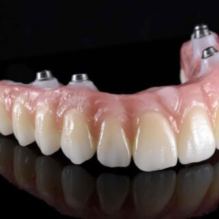 Zirconia Dental Prosthesis