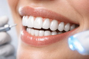 Teeth Whitening - تبييض الأسنان